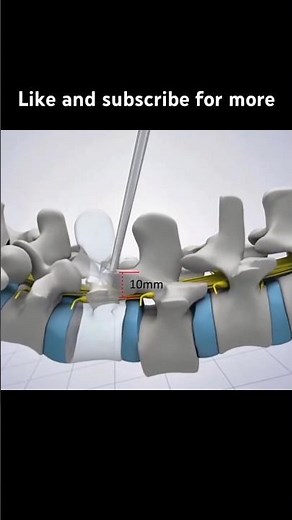 Spinal Fixation Surgery Explained: Step-by-Step Guide #SpinalFixation #SpineSurgery #shorts