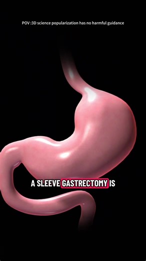 Sleeve Gastrectomy Surgery (3D Animation) #sleevegastrectomy #weightloss #weightlosssurgery #bariatricsurgery #sleevegastrectomie #sleevegastroplasty #medical3danimation #3dmedicalanimation