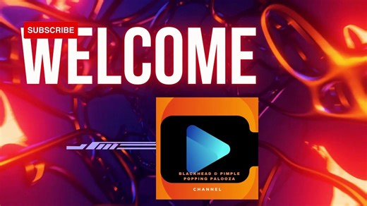 Massive Blackhead Removal from the Nose