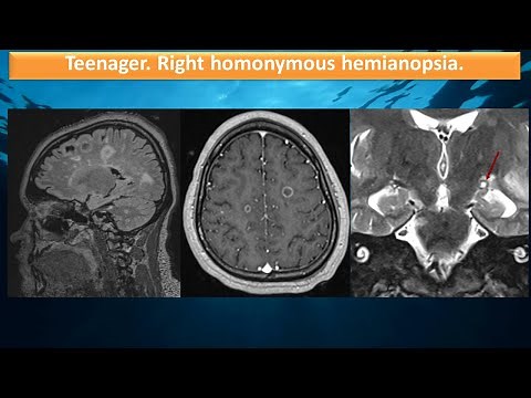 Teenager. Homonymous hemianopsia