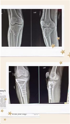 prxomial tibia fibula # with plating operation movement 😷