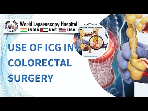 Exploring the Use of Indocyanine Green (ICG) in Colorectal Surgery - Steven D Wexner