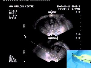 Transrectal Ultrasound Prostate Biopsy - Periprostatic Nerve Block • Video • MEDtube.net