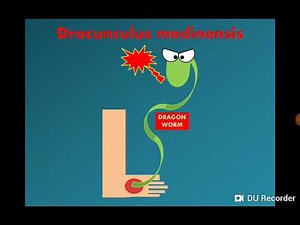 Dracunculus medinensis (Dracontiasis) الدودة التنين