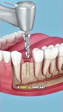 Tooth Extraction and Dental Implant Process Explained #dentist #orthodontist #veneers