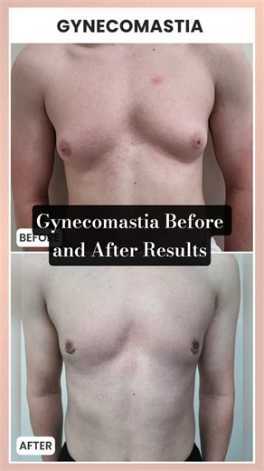 Gynecomastia Surgery Before and After | Real Patient Results at MPH