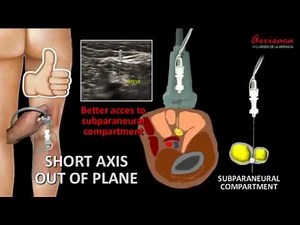 ALL YOU NEED TO KNOW ABOUT POPLITEAL SCIATIC NERVE BLOCK