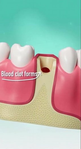 🦷 Tooth Extraction Healing Stages: What to Expect
