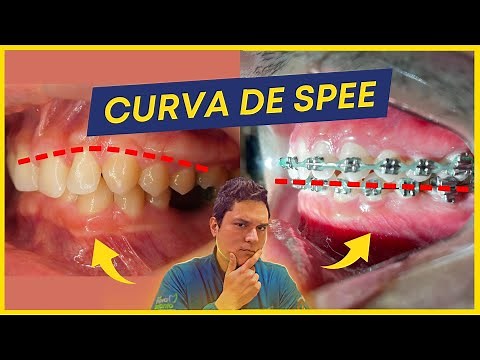 The Curve of Spee in Orthodontics and its Importance for Finishing.