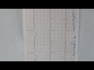 ventricular bigeminy and trigeminy
