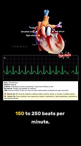 43K views · 593 reactions | Supraventricular Tachycardia, or SVT a rhythm that’s so fast, the P waves are often hidden inside the T waves.The rate usually ranges from 150 to 250 beats per minute, and the rhythm stays regular. #hearthealth #supraventriculartachycardia #MedG #education | Med G | Facebook