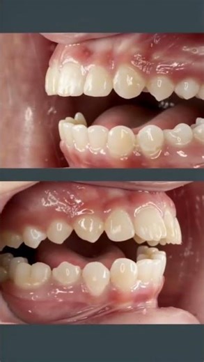 Fixing an Overbite Without Headgear #shorts