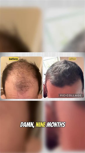 This is What Insane Hair Regrowth Actually Looks Like