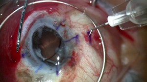 Penetrating Keratoplasty, Vitrectomy, and Scleral IOL - Eyetube