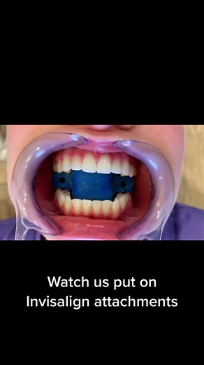 Ever wonder how Invisalign trays move teeth? The trays push on tooth colored bumps of glue bonded to the teeth called attachments. Watch this video to see how we put on Invisalign attachments! #invisalign #drwindhorst #choiceorthodontics #invisalignsmile #invisalignattachments #orthodontist #orthodontics