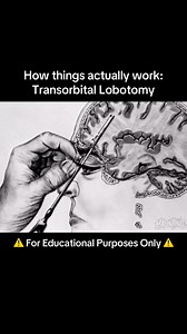 Warning: Disturbing footage of how Transorbital Lobotomy works. Made famous by Walter Freeman in the 1940s. #hauntingsofohio #paranormalactivity #medicaleducation #lobotomy #disturbing | Hauntings of Ohio