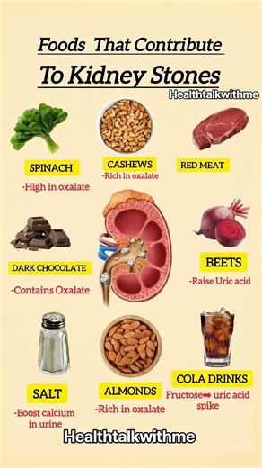 Foods that Contribute to kidney stones #healthylifestyle #healthyeating #healthtips