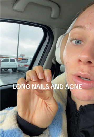Long Nails and Acne: Overcoming Beauty Challenges