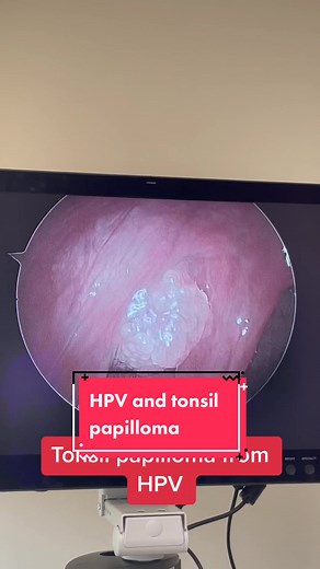Patient with right tonsil papilloma (benign) from previous HPV exposure. While this subtype of HPV is less aggressive, other subtypes may lead to throat cancer. #hpv #throatcancer #tonsils #ent #nj #newjersey