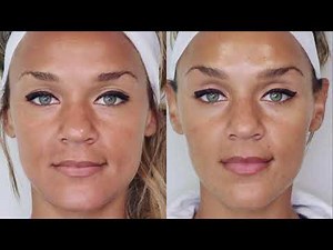 Eyebrow Lift with VSoft Lift PDO Threads