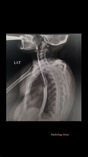 Barium Swallow, Or Esophagogram