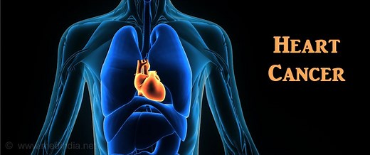 Heart Cancer - Causes, Symptoms, Complications, Diagnosis, Treatment & Prevention