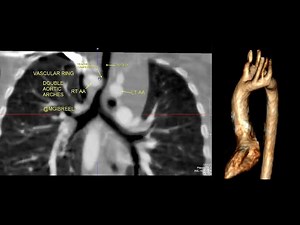 1 year child with stridor CT shows complete vascular ring , DAA ; Double Aortic Arches