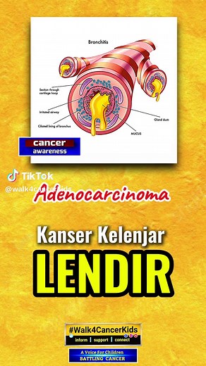 ADENOCARCINOMA: Adenocarcinoma is a type of cancer that starts in mucus-producing (glandular) cells. Many organs have these types of cells and adenocarcinoma can develop in any of these organs. Adenocarcinoma is the malignant counterpart to adenoma, which is the benign form of such tumors. The most commonly involved sites include the bones, lungs, liver, and lymph nodes, which represent nearly 60 percent of the cases. The most common type of adenocarcinomas comprises breast, lung, prostate, colo