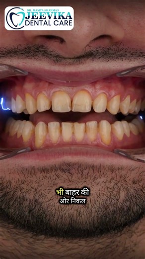 Missing Tooth Treatment in Jaipur | Dental Implant & Tooth Replacement | Jeevika Dental Care