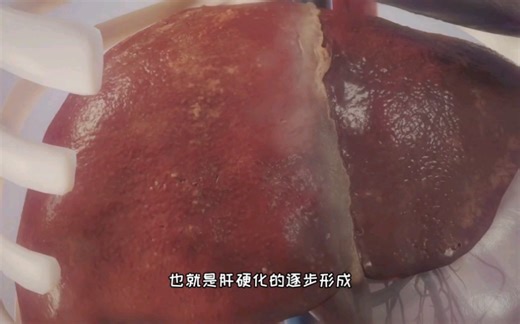 脂肪肝、酒精肝的形成过程和原因，3D演示。。