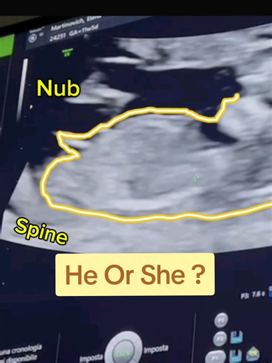 Baby Gender Prediction: Girl or Boy? Find Out Now!