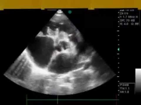 Atrioventricular Canal In Echocardiography Examination • Video • MEDtube.net