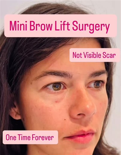 Botox La Belle Medspa on Instagram: "Mini Brow Lift (minimally invasive brow lift surgery) ✨ A mini brow lift is a small surgical procedure designed to lift the outer brow (tail of the eyebrow), open the eyes, and refresh a tired or heavy look—without a full facelift. What it corrects • Drooping brows (especially the outer brow) • Tired, sad, or angry-looking eyes • Mild brow asymmetry • Heavy upper eyelids (indirect improvement) How the procedure is done • Very small incisions hidden in the hai