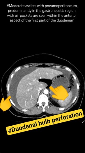 Duodenal bulb perforation CT scan finding #shortvideo