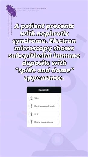 med's go on Instagram: "Membranous nephropathy presents with nephrotic syndrome and is characterized on electron microscopy by subepithelial immune complex deposits, which create the classic “spike and dome” appearance due to GBM projections forming between immune deposits. It is most commonly caused by autoantibodies against the PLA2R receptor on podocytes (primary form), but can also be secondary to malignancy, hepatitis B, SLE, or drugs. Complement activation (C5b-9) leads to podocyte injury