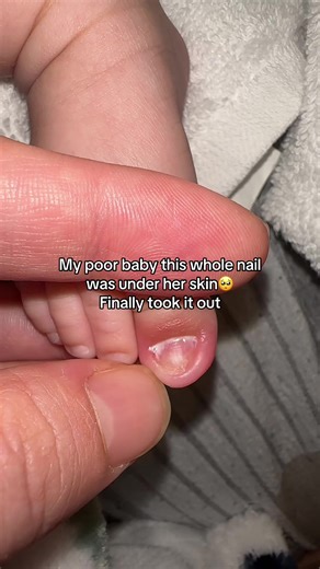 First of all I wanna say thank you so much to everyone again & again. i heard all your advices & did the best for her. I want to clear some points: 1. iv never cut her toenails or even touched them 2. I went to the Dr he gave me antibiotics but made her skin peel so I stopped and used another one 3. I can't risk going to ER as now it's too much viruses going around & my baby MayaLisa is not vaccinated yet (RSV , Flu A) 4. I called again my Dr to get referral to go P as in Canada we can't go spec