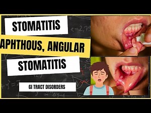 Stomatitis | Types of stomatitis | Inflammation of mouth and lips | Causes | Symptoms| Treatment..