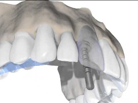 Implant Upper Front tooth with simple bone graft