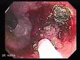 Tubulo - Villous Rectal Adenoma - Endoscopy (12 of 35) • Video • MEDtube.net