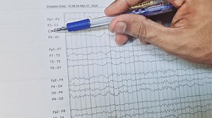 3.5K views · 121 reactions | Approach to EEG , Basics and Description of normal EEG !!!Please do Share with your colleagues. Abnormal EEGs and their description like in SSPE, Encephalopathy, Abscence seizures, juvenile myoclonic epilepsy and generalized epilepsy is already uploaded on YouTube. | Dr. Arshad Mehmood - Child Specialist | Facebook