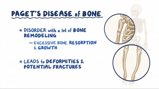 Video: Paget disease of bone - Video Explanation! | Osmosis | Osmosis
