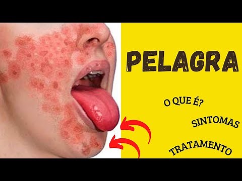 O Que é a Pelagra? | Quais os Sintomas da Pelagra? | Como Diagnosticar a Pelagra?
