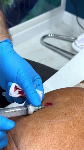 Non-Surgical & Painless BBL with Dr. Dahabra | Instant Lift Without Surgery! #shorts