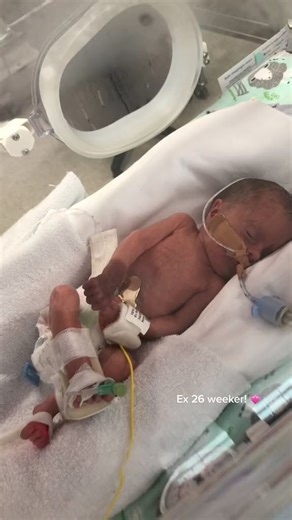 Miracle baby with a beautiful birthmark #nevus #birthmark #nevusawareness #premmie | Nicu baby