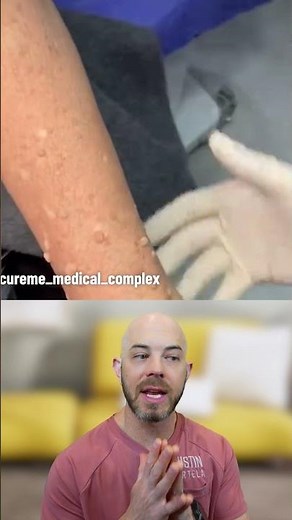 DOZENS and dozens of warts on the arm! (credit: @cureme_medical_complex on TT) #warts #skin