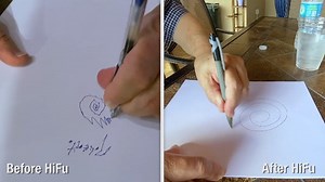 17 reactions | If you need to know how much "essential tremor" can disrupt your life, just ask Roberto Rodriguez, who recently underwent HiFU, a revolutionary non-invasive procedure at Miami Neuroscience Institute with the most advanced technology. "I’m feeling brand new again," he says. https://bit.ly/3eaOOhR | Baptist Health | Facebook