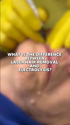 Electrolysis vs. Laser Hair Removal