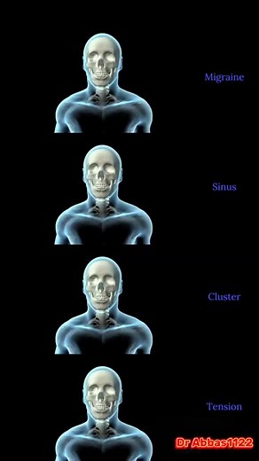 3.4K views · 32 reactions | Different types of headache | Medical Information | Facebook