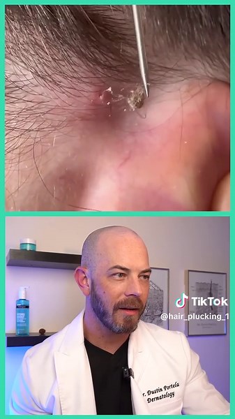Doctor reacts to impacted ingrown hair removal! #doctor #doctorreacts #viral #satisfying #foryoupage #skincare #fypシ #healthy #pimplepop