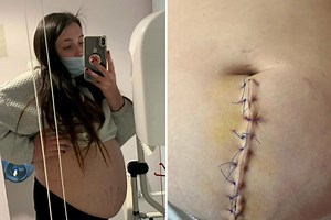 Teen stunned to find out real reason for her 'nine month's pregnant belly'